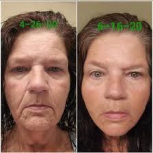 Pomifera Rejuvenation With Jennifer