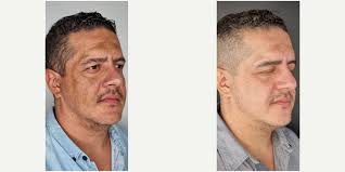 Top Chemical Peel Providers in Colombia