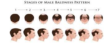 These days, however, a visit to a dermatologist can lead to a diagnosis that can help to treat and even reverse the condition. Dermatologist Treatment Of Male Pattern Baldness Mphl Orlando Dermatology Center
