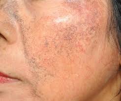 Image result for Postinflammatory Hyperpigmentation