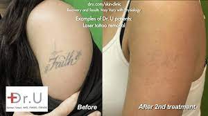 Dermatologists have the medical training needed to consider your health and the health of your skin. Video Dr U Answers Your Questions Tattoo Removal With Laser La