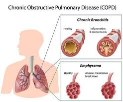 Dynamic airway collapse causes a rapid fall. Ø£Ø³Ø¨Ø§Ø¨ Ø§Ù„Ø§Ù†Ø³Ø¯Ø§Ø¯ Ø§Ù„Ø±Ø¦ÙˆÙŠ ÙÙ‚Ø¯Ø§Ù† Ø§Ù„ÙˆØ²Ù† ÙˆÙ…Ø±Ø¶ Ø§Ù„Ø§Ù†Ø³Ø¯Ø§Ø¯ Ø§Ù„Ø±Ø¦ÙˆÙŠ Ø§Ù„Ù…Ø²Ù…Ù†Ù‡