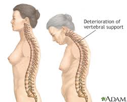 Aging Changes In The Bones Muscles Joints Information Mount Sinai New York