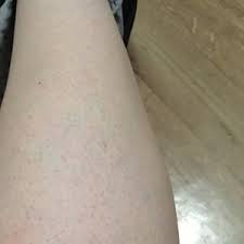 Are These Green Veins Normal Photos