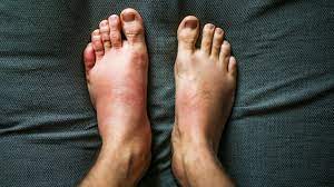 Swelling: Is It Serious? Symptoms, Causes, And Treatment