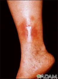 Image result for Stasis Dermatitis
