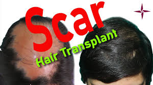 It can be caused by a diverse group of rare disorders that destroy the hair follicle, replace it with scar tissue, and cause permanent hair loss. Scar Hair Transplant How To Produce Good Growth In Scar Tissue And Cover The Area Aesthetically Youtube