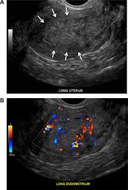 Survival rates for endometrial cancer. Imaging And Staging Of Endometrial Cancer Sciencedirect