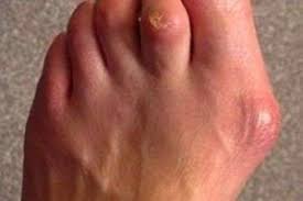 Pin On Corns