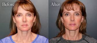 Facial Plastic Surgeon in Denver, CO