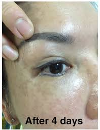 laser eyebrow embroidery tattoo removal
