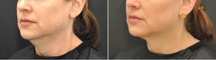 Through the magic of makeup, you can reduce the appearance of jowls. Can I Tighten Skin On My Neck And Face Without Surgery Boston Ultherapy Krauss Dermatology