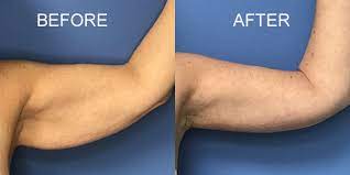 How To Get Rid Of Flabby Arms Loose Arm Skin Dr Ali