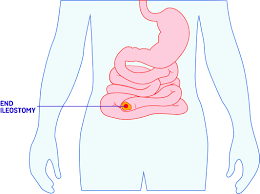 Living With A Stoma Crohn S Colitis Uk