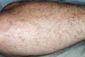 Usually the only symptom is pain at the site which may. Insect Bites And Stings Symptoms Nhs