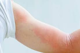 Check spelling or type a new query. Urtikaria Hives Jenis Simptom Punca Diagnosis Faktor Risiko Dan Rawatan Ceriasihat