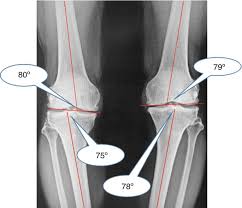 Image result for Genu Varum