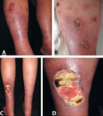 Image result for liver spots on legs