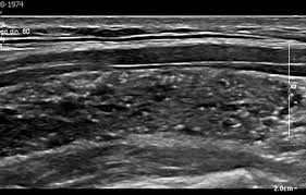 They may be hyperplastic or tumorous, but only a small percentage of thyroid tumors are malignant. Thyroid Microcalcifications In The Absence Of Identifiable Nodules And Their Association With Thyroid Cancer Whittle 2019 Journal Of Ultrasound In Medicine Wiley Online Library