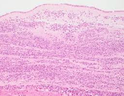 Image result for Chorioamnionitis