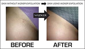 These impacted materials are the source of bacterial infections associated with ingrown hairs. Review Analysis Pros Cons Wizker Original Ingrown Hair Bump Away Brush Wet Dry Skin Firm Flex Exfoliation Eliminates Prevents Razor Bumps Ingrown Hairs