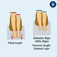 Image result for Galeazzi Sign