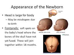 Sagittal synostosis (scaphocephaly) is the most common type. How Many Soft Spots Does A Newborn Baby Have Newborn Baby