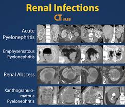 Image result for Acute Pyelonephritis