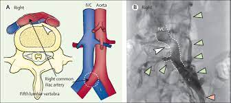 A Hairdresser S Painful Swollen Left Leg Artery Compresses Vein In May Thurner Syndrome The Lancet