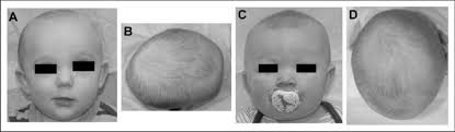 Image result for Positional Head Deformity