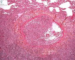 Occurs in persons with asthma and those with cystic fibrosis (cf). Aspergillus Sp Humpath Com Human Pathology