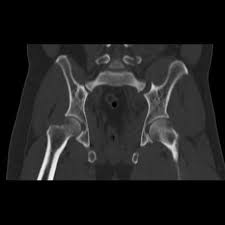 Transverse Process Fracture Radiology Reference Article Radiopaedia Org