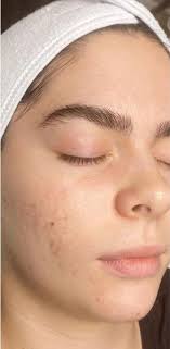 Medical Grade Chemical Peel