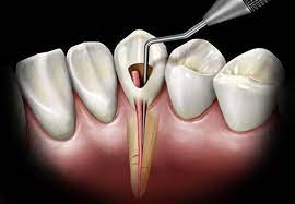 Toothpaste that gives you a healthy smile, with specialized solutions tailored to you. Root Canal Treatment Procedure Nha Khoa Numberone