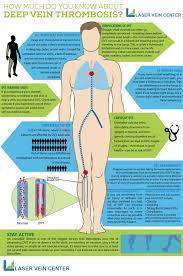 How Much Do You Know About Deep Vein Thrombosis Laser Vein Center Vein Thrombosis Deep Vein Thrombosis Thrombosis