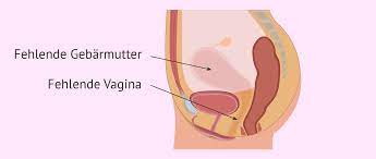 Sultan et al., 2009 being the second most common cause of primary amenorrhea timmreck and reindollar. Kuster Hauser Syndrom