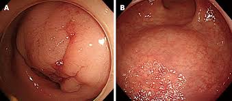 By better understanding the polymorphic appearance of endometriosis, it will improve our diagnostic potential without having to rely on pathology. Intestinal Endometriosis Diagnostic Ambiguities And Surgical Outcomes