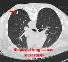 A buildup of fluid between the membranes lining the lungs (pleural effusion) 1 ﻿ is also common and is usually heralded by rapidly increasing shortness of breath. Lung Metastases Ucla Interventional Oncology Los Angeles Ca