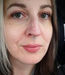 I have been battling squamous cell carcinoma