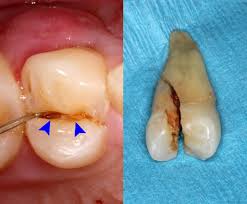 Image result for Tooth Fracture