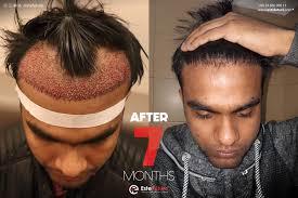 Hair Transplant Result After 7 Months At Este Future In Turkey Hair Transplant Results Hair Transplant Hair Loss Medication