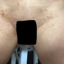 Fear of the unknown can be paralyzing when you discover an unusual lump or an abnormal function. How Can I Treat Ingrown Scars In My Bikini Area Around My Vagina Photos