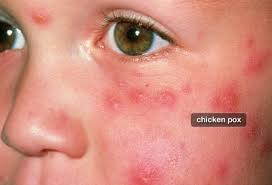 Image result for shingles in children