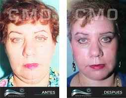 Rejuvenecimiento Facial