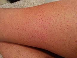 You can use ice or cold packs immediately after the laser treatment, so put them in the freezer before your appointment. My Legs Are Burnt After Laser Hair Removal Will It Be Permanent Photo