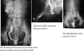 Image result for Intravenous Pyelogram