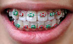 Some people will shrug off the breathing becomes difficult and the lungs get inflamed. Wearing Braces How Long Do Braces Take To Work