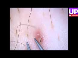 Ingrown hair prevention to prevent ingrown hairs, try these tips when you shave: Ingrown Hair Trapped In Scab On Belly Youtube