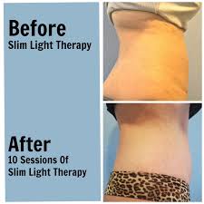 It is a suitable procedure for those who are at their ideal weight but wish to eradicate stubborn deposits of fat. Coolsculpting Gone Bad Barbie S Beauty Bits