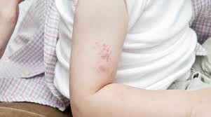 Check spelling or type a new query. Ù…Ø­Ø±Ø¬ Ù„ÙˆÙ† Ø§Ù„Ø²Ù‡Ø± Ù…Ø¹Ø·Ù Ù…Ø§Ù‡ÙŠ Ø§Ù„Ø§Ù…Ø±Ø§Ø¶ Ø§Ù„ØªÙŠ ØªØ´Ø¨Ù‡ Ø§Ù„Ø­Ø²Ø§Ù… Ø§Ù„Ù†Ø§Ø±ÙŠ Appliancerepairissaquah Com